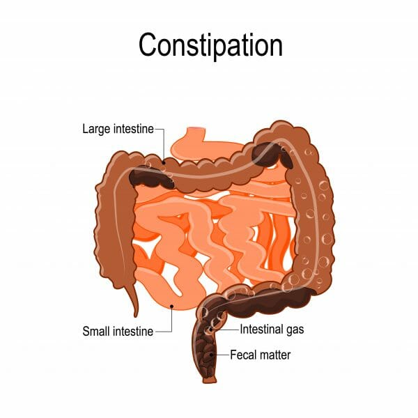 Constipação intestinal (prisão de ventre)